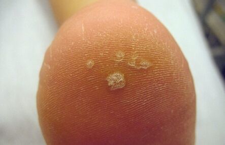 Hoe u een Pierce Wrat herkent
