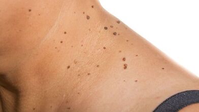 Hoe u van papilloma om de nek af kunt komen