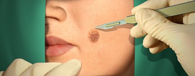 Chirurgische behandeling van papilloma