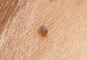 Klinisch beeld van papilloma