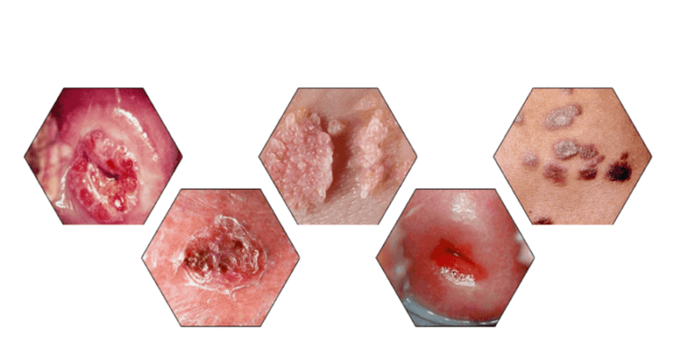 Waarom zijn papillomen gevaarlijk