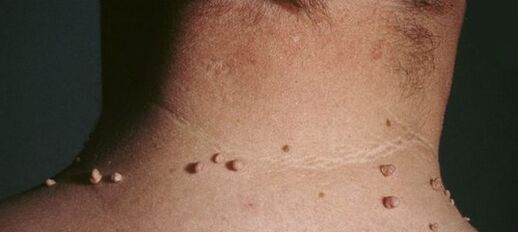 hoe zich te ontdoen van papillomen