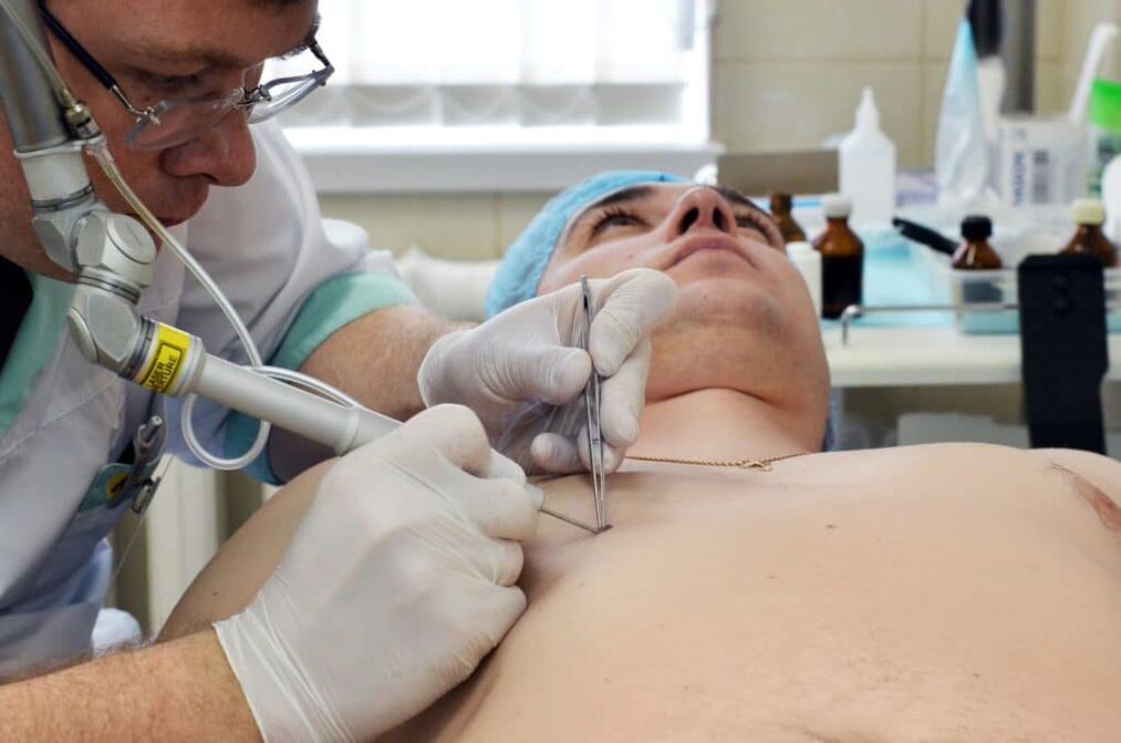 hoe zich te ontdoen van wratten op het lichaam