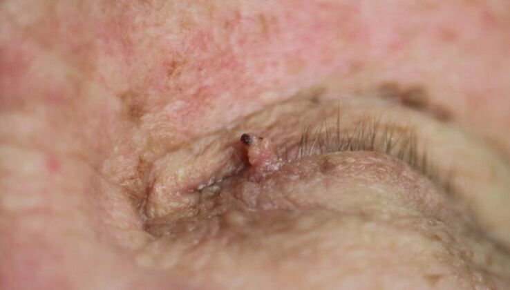 papilloma op het ooglid hoe kom je er vanaf
