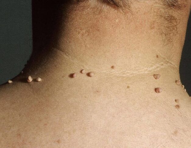 Papilloma's in de nek van een man