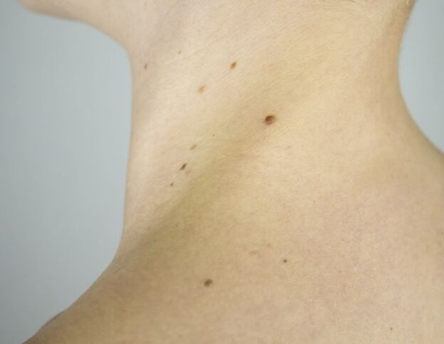 Papilloma's in de nek van een meisje