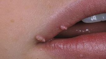 Papillomen op de lippen