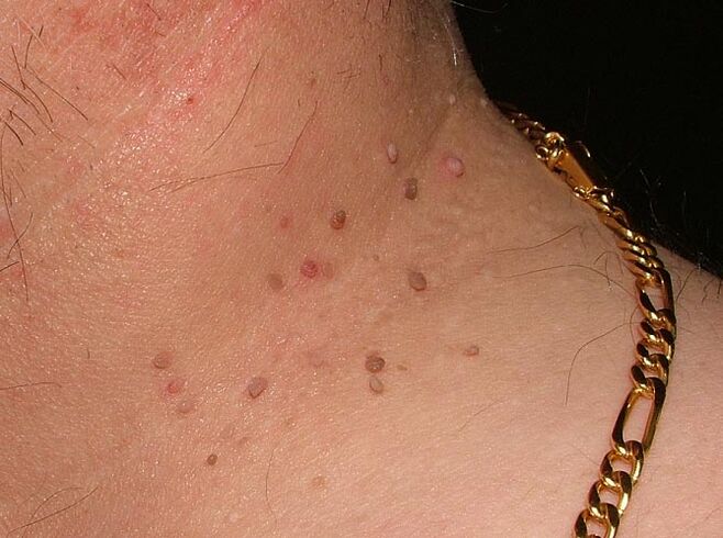 Papilloma's in de nek