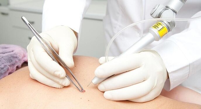 laserverwijdering van papilloma voor papillomavirus