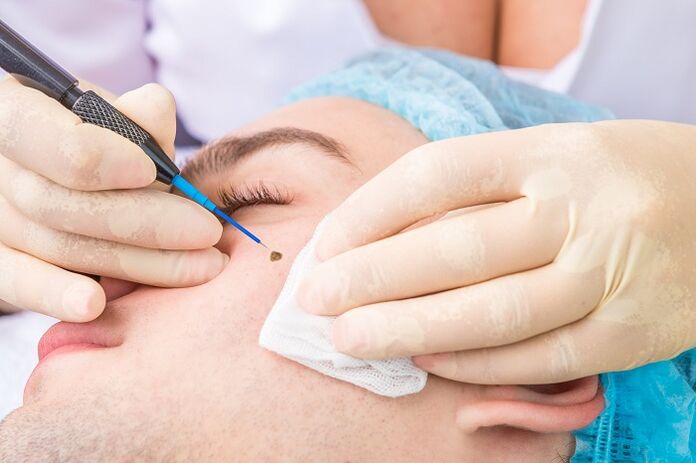verwijdering van papilloma op het gezicht als gevolg van het humaan papillomavirus