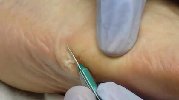 Chirurgische verwijdering van een plantaire wrat